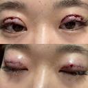 二重切開 つだ美容外科クリニック AFTER サムネイル用