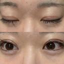 二重切開 つだ美容外科クリニック DAY 0 サムネイル用
