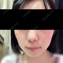 光治療（フォトフェイシャルなど） トラスト美容クリニック 銀座院 AFTER サムネイル用