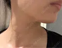 インモード 名古屋美容外科 AFTER サムネイル用
