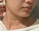 インモード 名古屋美容外科 DAY 15 サムネイル用