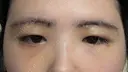 上まぶたの脂肪取り / 眉下切開 新宿美容外科ネビュラクリニック DAY 8 サムネイル用