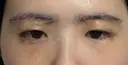 上まぶたの脂肪取り / 眉下切開 新宿美容外科ネビュラクリニック DAY 9 サムネイル用