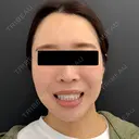 糸リフト / メーラーファット除去 / ジョールファット除去 BLINC CLINIC （ブリンク クリニック） DAY 90 サムネイル用