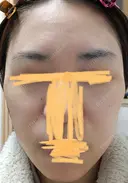 肌育注射（ジュベルックなど） LA MER CLINIC DAY 29 サムネイル用