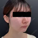 糸リフト / ジョールファット除去 BLINC CLINIC （ブリンク クリニック） DAY 92 サムネイル用