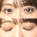 二重切開 EMMA CLINIC（エマクリニック） AFTER サムネイル用