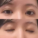二重埋没 アリエル美容クリニック 横浜院 DAY 5 サムネイル用