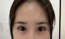 目尻切開 / タレ目形成・グラマラスライン（切開） BIANCA銀座 AFTER サムネイル用