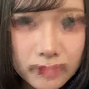 鼻尖形成（切開） / 小鼻縮小（切開） / ワシ鼻修正・ハンプ切除 / 鼻修正 / 鼻尖縮小 / 真皮移植 LUHO（ルホ）美容外科 AFTER サムネイル用
