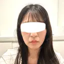 脂肪吸引注射（顔） 新宿美容外科ネビュラクリニック AFTER サムネイル用