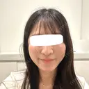 脂肪吸引注射（顔） 新宿美容外科ネビュラクリニック DAY 37 サムネイル用