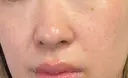 ルメッカ / LDM・インテンスウルトラ Chloe Cheongdam Clinic （クロエチョンダムクリニック） DAY 7 サムネイル用