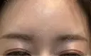ボトックス（あご） / ボトックス（眉間） / ボトックス（額） Belle Via Clinic DAY 7 サムネイル用
