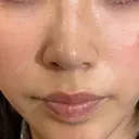 ピーリング（ハリ・ツヤ） HAAB CLINIC 池袋院 DAY 0 サムネイル用