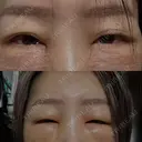 クマ治療 / 脂肪注入（額） / 脂肪注入（目の下） eクリニック 福岡院 AFTER サムネイル用