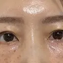 クマ治療 / 脂肪注入（額） / 脂肪注入（目の下） eクリニック 福岡院 DAY 31 サムネイル用