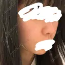 肌ヒアルロン酸注入（たるみ・シワ改善） / ボトックス（額） TCB東京中央美容外科 佐賀院 DAY 1 サムネイル用
