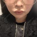 バッカルファット除去 / 脂肪吸引（顔） / あご下筋肉縛り セギム美容整形外科 DAY 31 サムネイル用