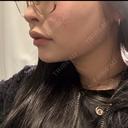 バッカルファット除去 / 脂肪吸引（顔） / あご下筋肉縛り セギム美容整形外科 DAY 31 サムネイル用