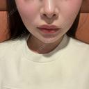 バッカルファット除去 / 脂肪吸引（顔） / あご下筋肉縛り セギム美容整形外科 AFTER サムネイル用
