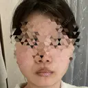 糸リフト / 脂肪吸引注射（顔） / ボトックス（あご） / ボトックス（エラ・小顔） / ボトックス（肩） TCB東京中央美容外科 立川院 DAY 3 サムネイル用