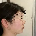 糸リフト / 脂肪吸引注射（顔） / ボトックス（あご） / ボトックス（エラ・小顔） / ボトックス（肩） TCB東京中央美容外科 立川院 DAY 3 サムネイル用