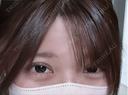 二重埋没 / ヒアルロン酸注入（涙袋） / ヒアルロン酸注入（あご） アリエル美容クリニック 郡山院 DAY 35 サムネイル用