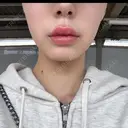 ヒアルロン酸注入（唇） Wing clinic 豊中駅前院 AFTER サムネイル用