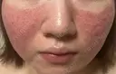 肌育注射（ジュベルックなど） / ニキビ治療 / ピーリング（ニキビ・毛穴） / ピコフラクショナルレーザー（毛穴・ニキビ跡） 新宿Ladies&Gentlemen美容クリニック DAY 16 サムネイル用