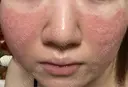 肌育注射（ジュベルックなど） / ニキビ治療 / ピーリング（ニキビ・毛穴） / ピコフラクショナルレーザー（毛穴・ニキビ跡） 新宿Ladies&Gentlemen美容クリニック DAY 27 サムネイル用