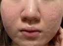 肌育注射（ジュベルックなど） / ニキビ治療 / ピーリング（ニキビ・毛穴） / ピコフラクショナルレーザー（毛穴・ニキビ跡） 新宿Ladies&Gentlemen美容クリニック AFTER サムネイル用