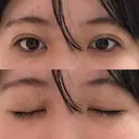 二重埋没 アリエル美容クリニック 横浜院 DAY 6 サムネイル用