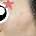 ルメッカ / LDM・インテンスウルトラ Chloe Cheongdam Clinic （クロエチョンダムクリニック） DAY 0 サムネイル用