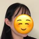 骨切り（あご） / 骨削り（エラ） / 骨削り（頬） セギム美容整形外科 DAY 92 サムネイル用