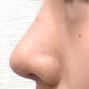 軟骨移植 / ワシ鼻修正・ハンプ切除 LUHO（ルホ）美容外科 DAY 183 サムネイル用