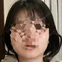 糸リフト / 脂肪吸引注射（顔） / ボトックス（あご） / ボトックス（エラ・小顔） / ボトックス（肩） TCB東京中央美容外科 立川院 DAY 4 サムネイル用