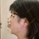 糸リフト / 脂肪吸引注射（顔） / ボトックス（あご） / ボトックス（エラ・小顔） / ボトックス（肩） TCB東京中央美容外科 立川院 DAY 4 サムネイル用