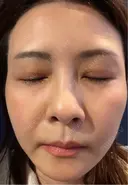 肌育注射（ジュベルックなど） / その他（肌） けやき美容クリニック 沼津院 DAY 2 サムネイル用