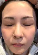 肌育注射（ジュベルックなど） / その他（肌） けやき美容クリニック 沼津院 DAY 3 サムネイル用