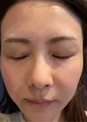 肌育注射（ジュベルックなど） / その他（肌） けやき美容クリニック 沼津院 DAY 14 サムネイル用
