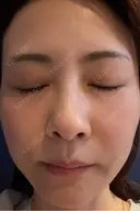肌育注射（ジュベルックなど） / その他（肌） けやき美容クリニック 沼津院 DAY 15 サムネイル用
