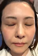 肌育注射（ジュベルックなど） / その他（肌） けやき美容クリニック 沼津院 AFTER サムネイル用