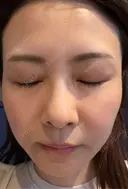 ダーマペン けやき美容クリニック 沼津院 DAY 3 サムネイル用
