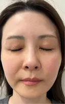 ダーマペン けやき美容クリニック 沼津院 DAY 4 サムネイル用