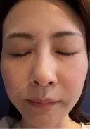 ダーマペン けやき美容クリニック 沼津院 DAY 6 サムネイル用