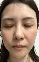 ダーマペン けやき美容クリニック 沼津院 DAY 7 サムネイル用