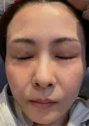ダーマペン けやき美容クリニック 沼津院 DAY 9 サムネイル用