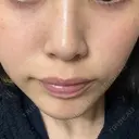 ピーリング（ハリ・ツヤ） HAAB CLINIC 池袋院 AFTER サムネイル用