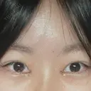 目頭切開 HAAB×DREAM BEAUTY CLINIC 大阪梅田院 DAY 2 サムネイル用
